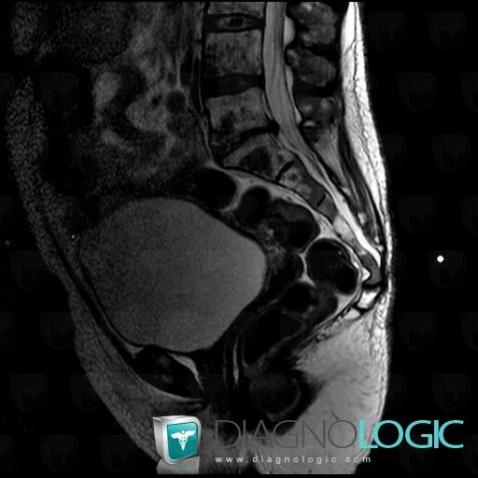 Métastase, Sacrum / Coccyx, IRM