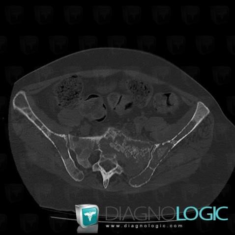 Métastase, Sacrum / Coccyx, Scanner