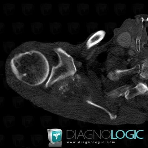 Métastase, Scapula, Scanner