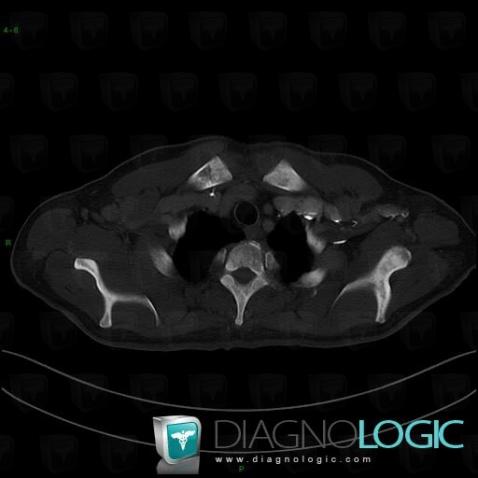 Métastase, Scapula, Scanner