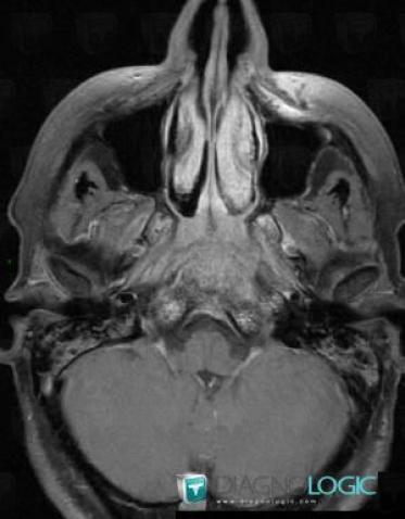 Métastase, Sphenoïde, IRM