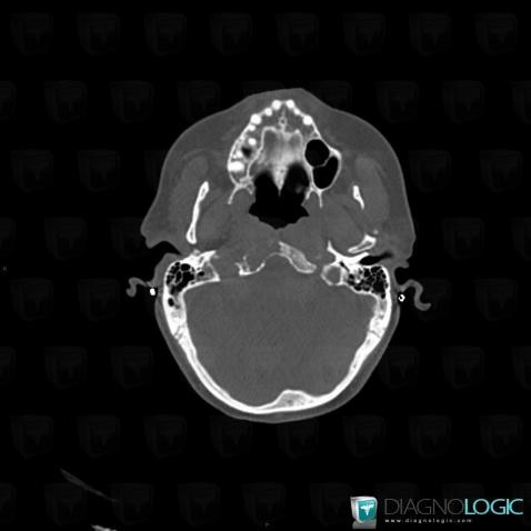 Métastase, Sphenoïde, Scanner