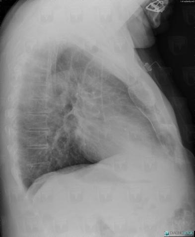 Métastase, Sternum, Radio