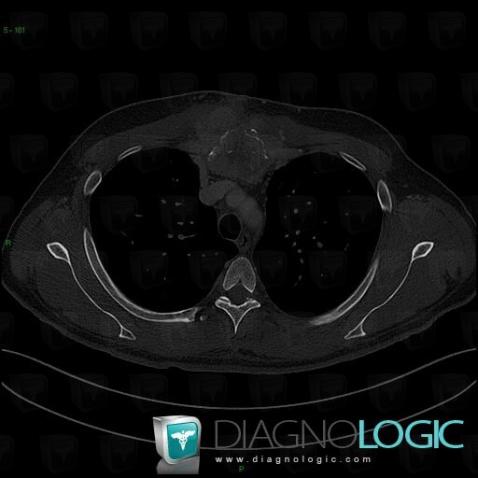 Métastase, Sternum, Scanner