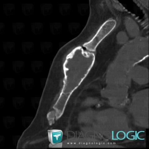 Métastase, Sternum, Scanner