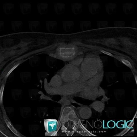 Métastase, Sternum, Scanner