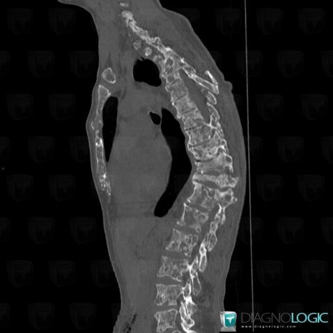 Métastase, Sternum, Scanner