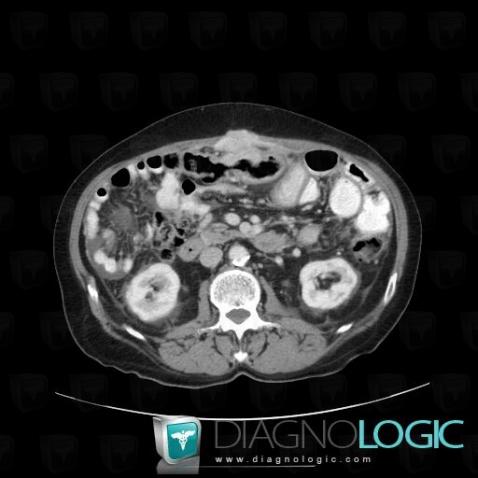 Metastasis, Abdominal wall, CT