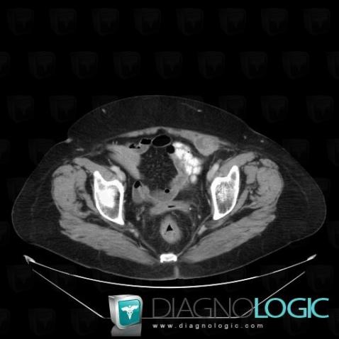 Metastasis, Abdominal wall, CT