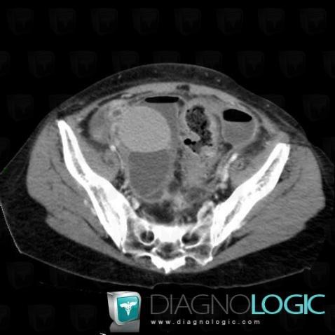 Metastasis, Adnexa / Ovary fallopian tube, CT