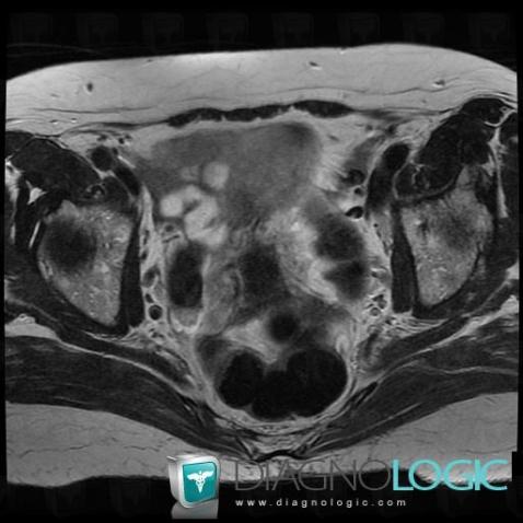 Metastasis, Adnexa / Ovary fallopian tube, MRI