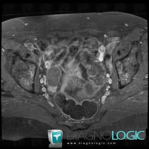 Metastasis, Adnexa / Ovary fallopian tube, MRI