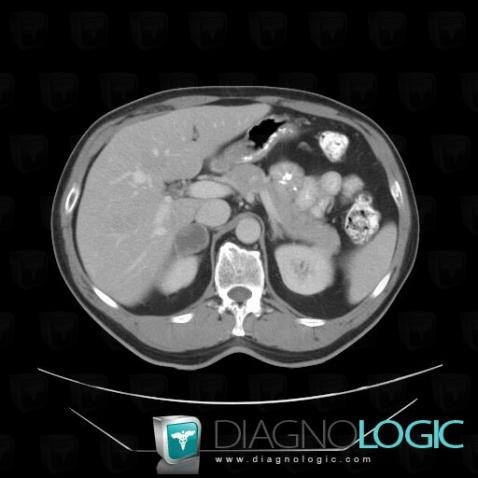 Metastasis, Adrenal glands, CT