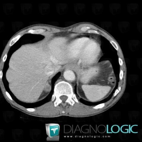 Metastasis, Adrenal glands, CT