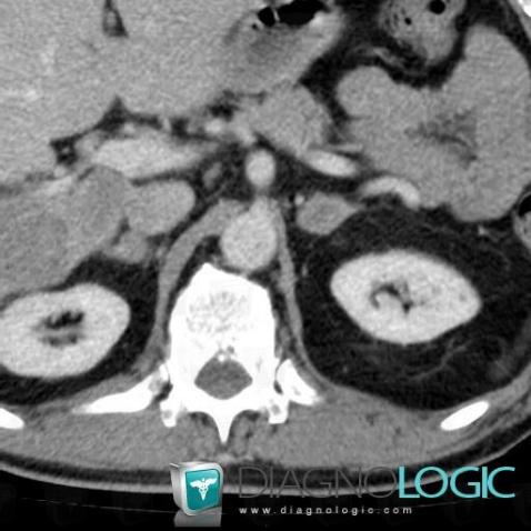 Metastasis, Adrenal glands, CT