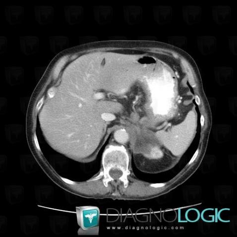 Metastasis, Adrenal glands, CT