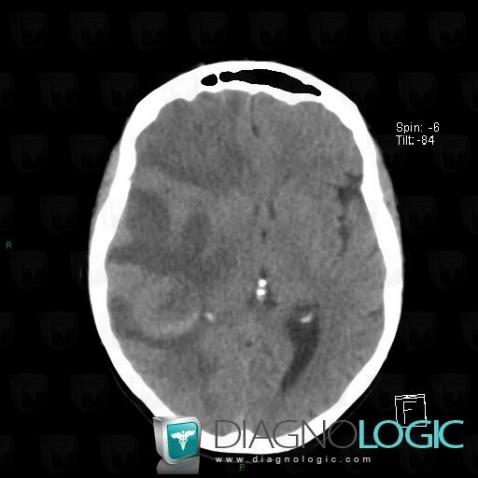 Metastasis, Basal ganglia and capsule, CT