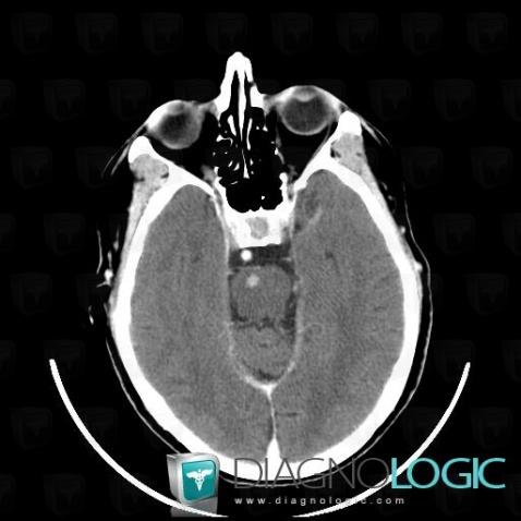 Metastasis, Brainstem, CT