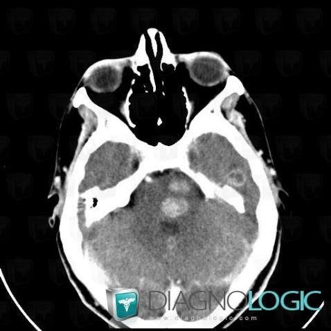 Metastasis, Brainstem, CT