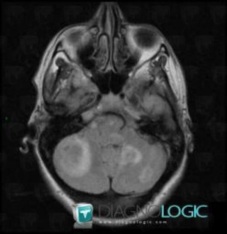 Metastasis, Brainstem, MRI