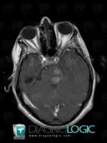 Metastasis, Brainstem, MRI