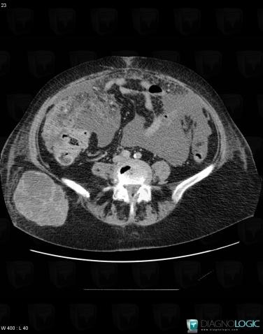 Metastasis, Caecum / Appendix, Other soft tissues/nerves - Pelvis, CT