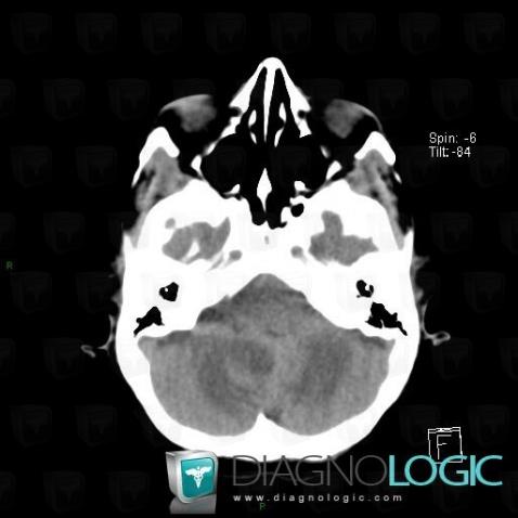 Metastasis, Cerebellar hemisphere, CT