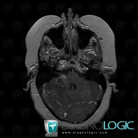 Metastasis, Cerebellar hemisphere, MRI