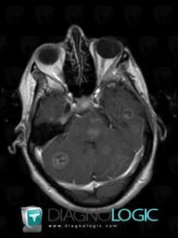 Metastasis, Cerebellar hemisphere, MRI