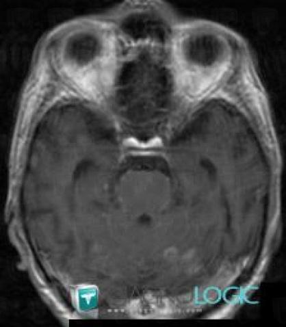Metastasis, Cerebellar hemisphere, MRI
