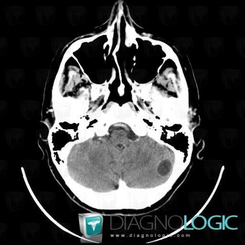 Metastasis, Cerebellar hemisphere, Posterior fossa, CT