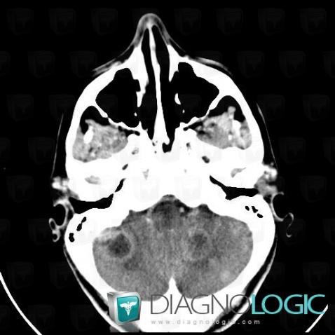 Metastasis, Cerebellar hemisphere, Posterior fossa, CT