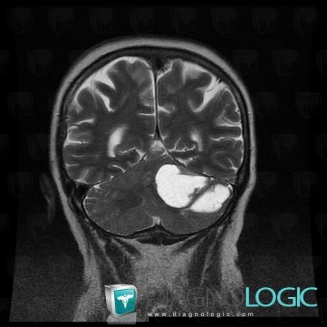 Metastasis, Cerebellar hemisphere, Posterior fossa, MRI