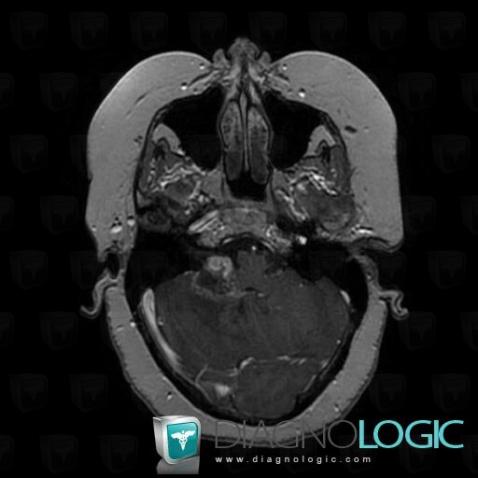 Metastasis, Cerebellopontine angle, Posterior fossa, MRI