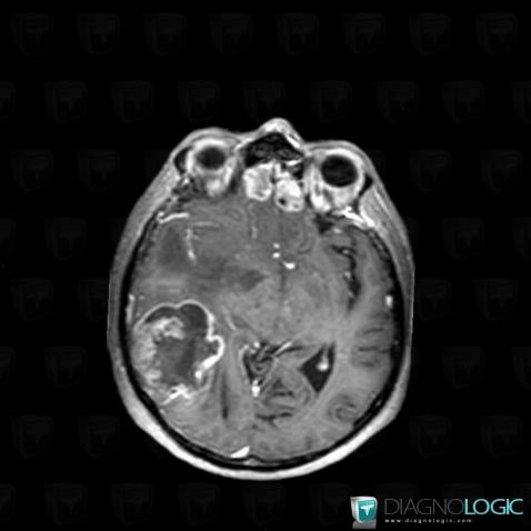 Metastasis, Cerebral falx / Midline, MRI