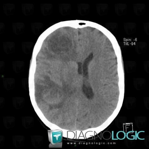 Metastasis, Cerebral hemispheres, Basal ganglia and capsule, CT