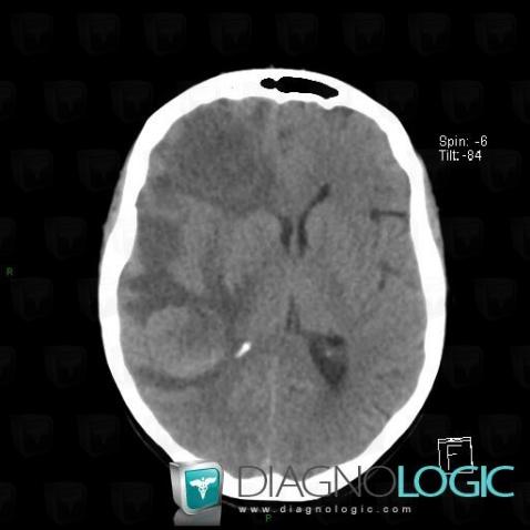 Metastasis, Cerebral hemispheres, CT