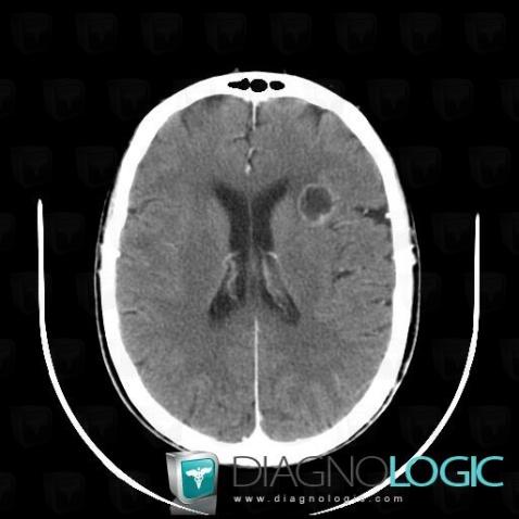 Metastasis, Cerebral hemispheres, CT