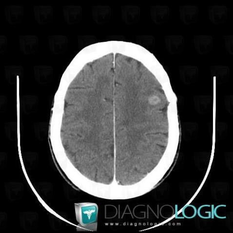 Metastasis, Cerebral hemispheres, CT