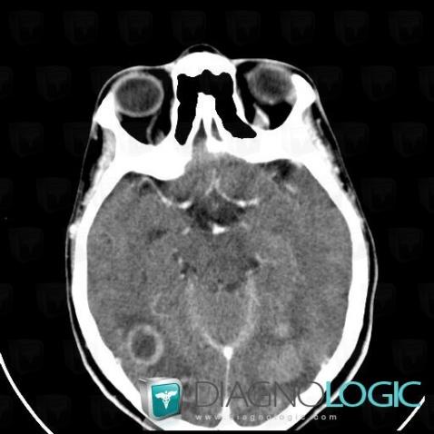 Metastasis, Cerebral hemispheres, CT