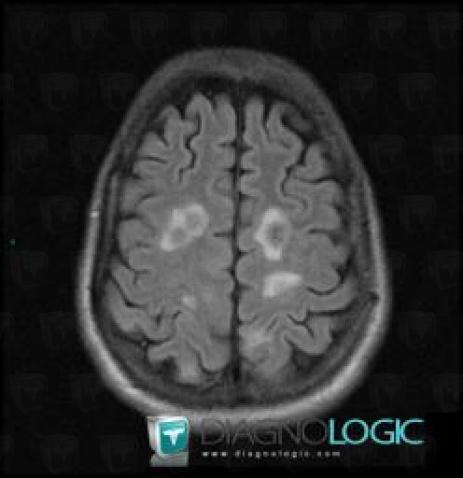 Metastasis, Cerebral hemispheres, MRI