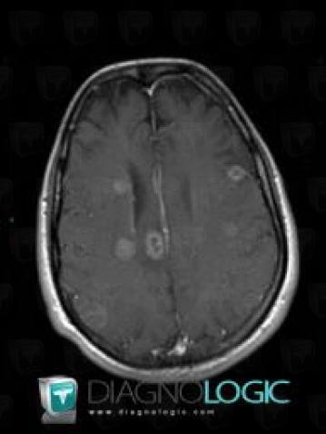 Metastasis, Cerebral hemispheres, MRI