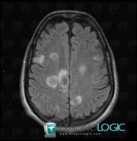 Metastasis, Cerebral hemispheres, MRI