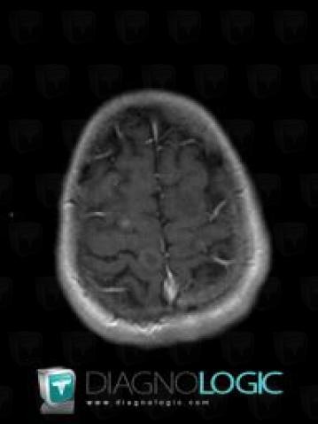 Metastasis, Cerebral hemispheres, MRI