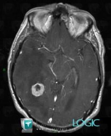 Metastasis, Cerebral hemispheres, MRI