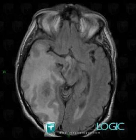 Metastasis, Cerebral hemispheres, MRI