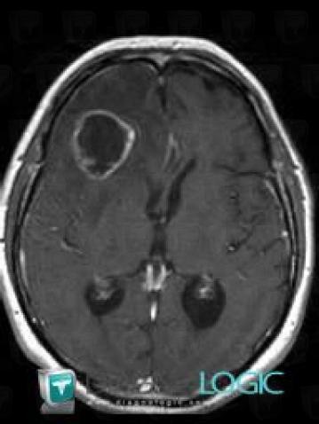 Metastasis, Cerebral hemispheres, MRI