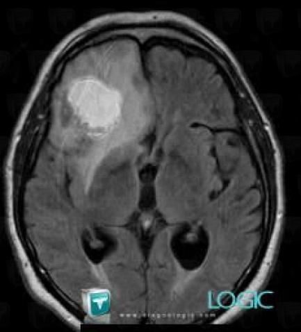 Metastasis, Cerebral hemispheres, MRI