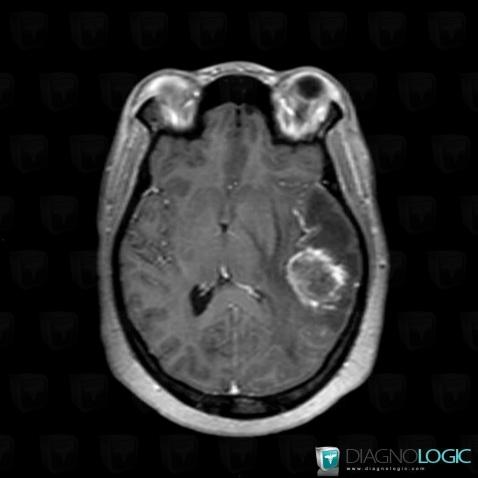 Metastasis, Cerebral hemispheres, MRI