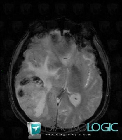 Metastasis, Cerebral hemispheres, MRI